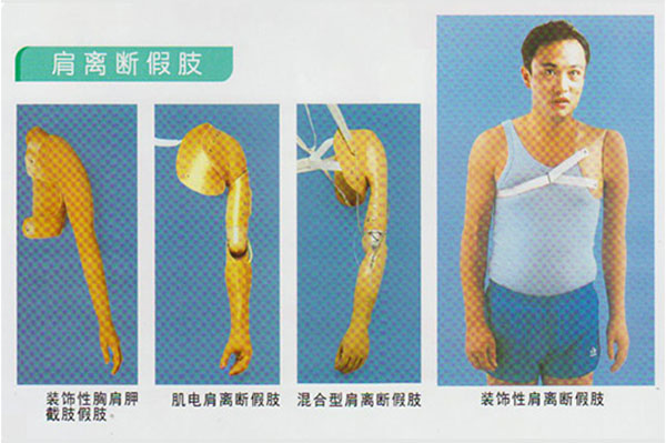 肩离断假肢